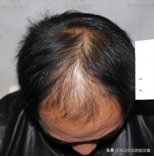 好?育发液什么牌子最有效果?开元棋牌日本生发液哪个牌子最(图3) 好?育发液什么牌子最有效果?开元棋牌日本生发液哪个牌子最(图3)